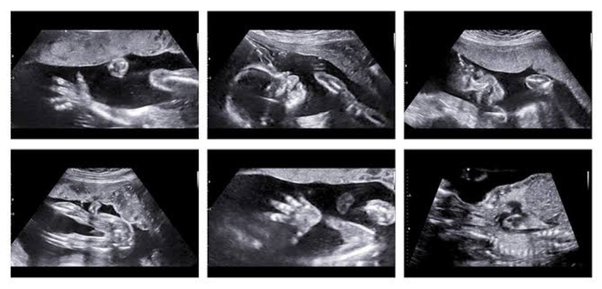 Anomaly / Detail Scan - Between 18 - 24 Weeks (Twins)